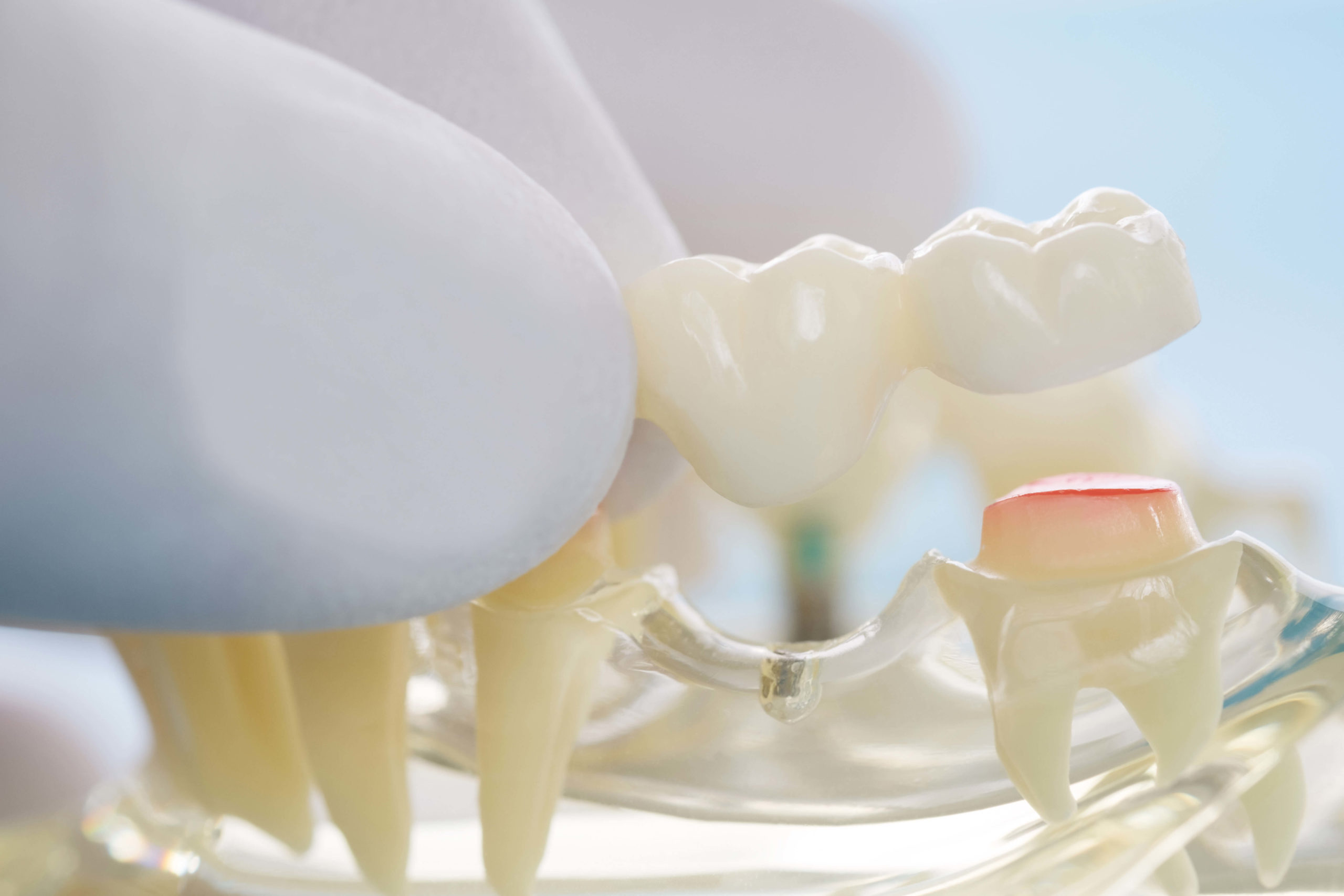 When Do Dental Crowns Need Replacement? The Smile Design